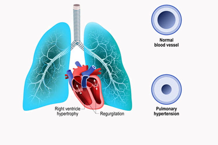 Evaluation And Management Of Pulmonary Hypertension In Non-Cardiac ...