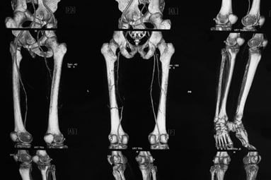 CT angiography imaging showing lower limb peripheral artery occlusive disease.