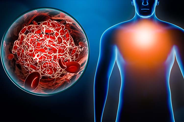 3D illustration of man with thrombus