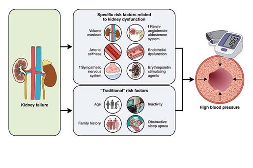 Infographic: Kidney Failure - Specific risk factors related to kidney dysfunction: Volume overload, Renin angiotensin aldosterone system, Arterial stiffness, Endothelial dysfunction, Sympathetic nervous system, Erythropoietin stimulating agents | Traditional risk factors: Age, inactivity, Family history, Obstructive sleep apnea - High blood pressure