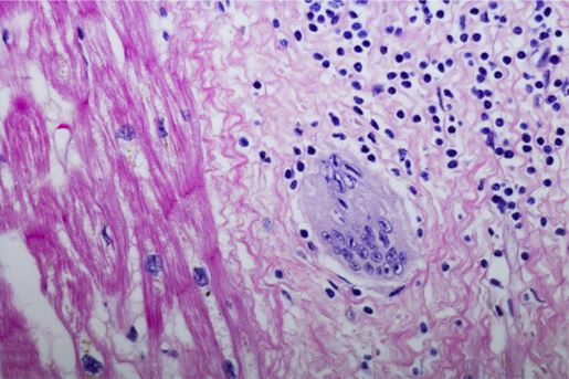 Cardiac Sarcoidosis
