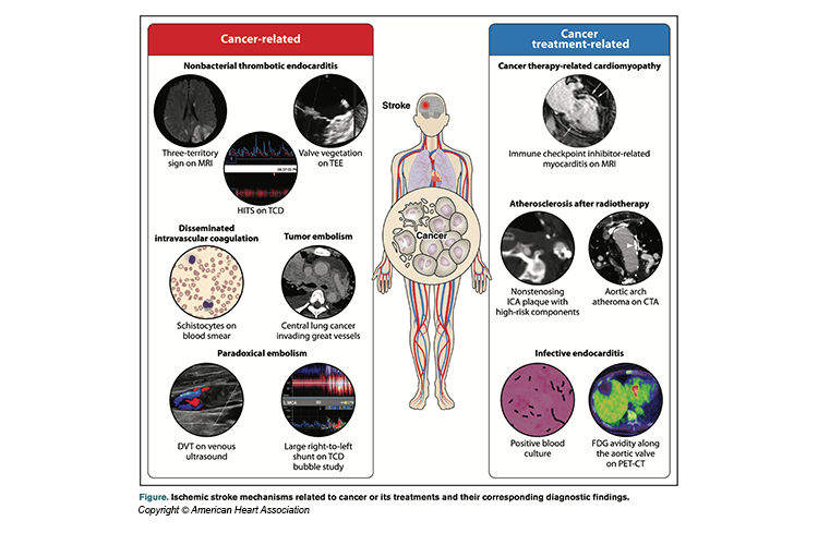 Figure showing Ischemic stroke mechanisms related to cancer and diagnostic findings