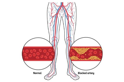 normal artery and blocked artery