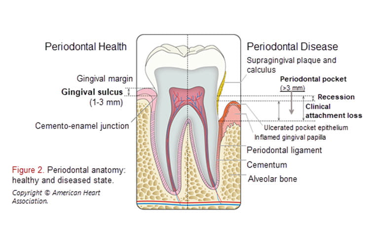 Illustration of periodontal anatomy: healthy and diseased state