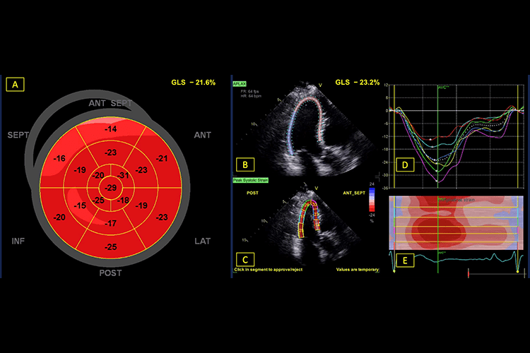 Example of a longitudinal strain assessment output in a patient with normal physiology